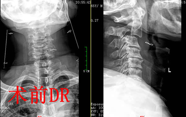 我院骨伤二科成功救治一例Hangman骨折（创伤性枢椎滑脱）患者(图2)