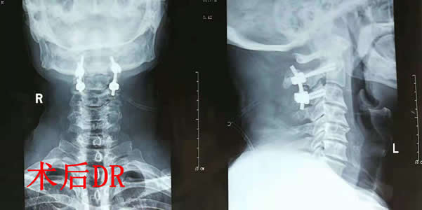 我院骨伤二科成功救治一例Hangman骨折（创伤性枢椎滑脱）患者(图3)