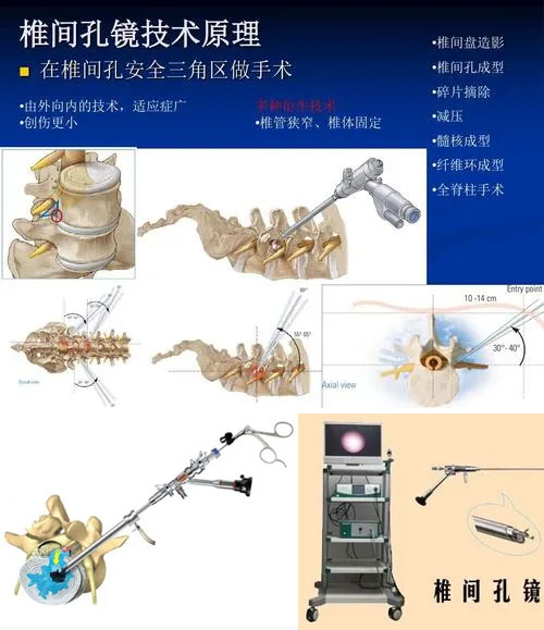 新设备丨弥勒市中医医院骨科新购入椎间孔镜系统，世界一流设备助力微创发展(图1)